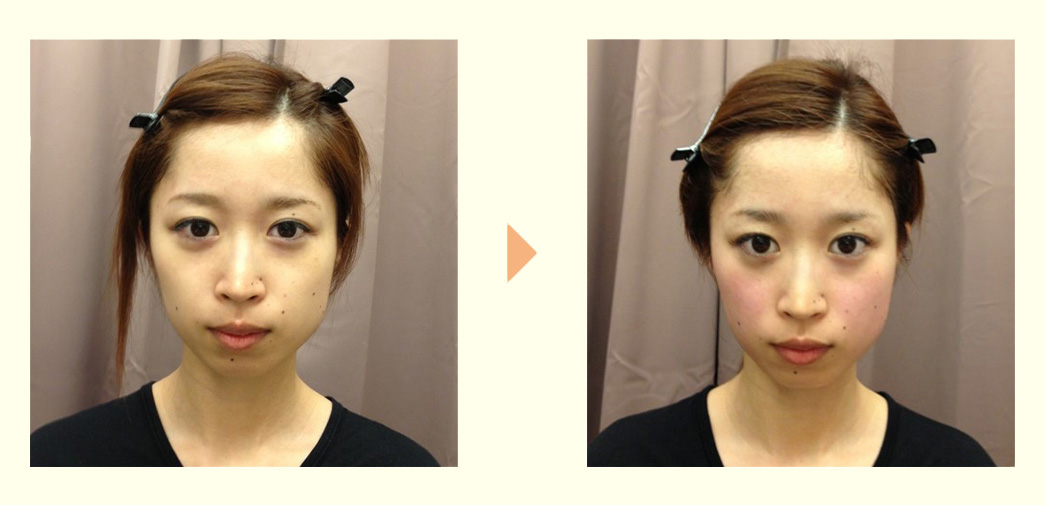 Before/AFTERの画像