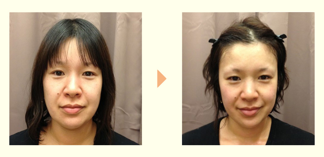 Before/AFTERの画像