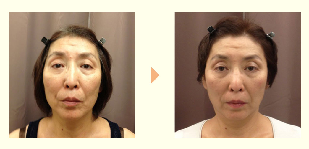 Before/AFTERの画像