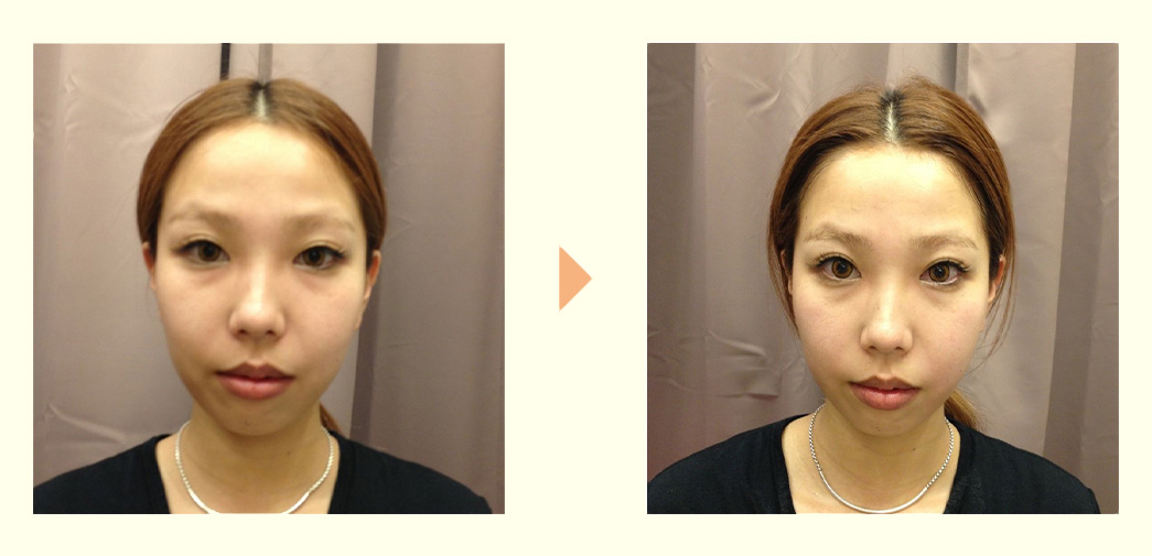 Before/AFTERの画像